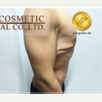 18-24 year old man treated with Total Abdominoplasty and Chest Surgery after 3649102