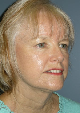 LiteLift™, Liposuction on 65-year-old Woman 423094