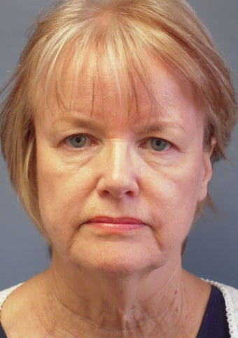 LiteLift™, Liposuction on 65-year-old Woman before 423094
