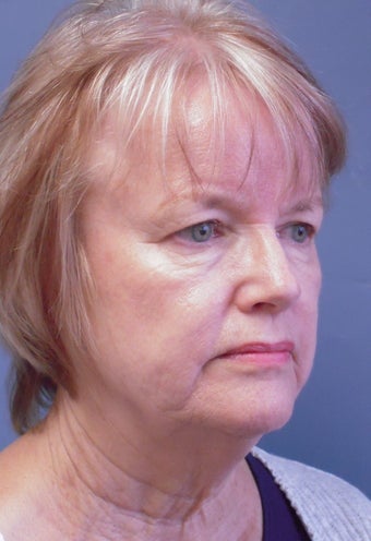 LiteLift™, Liposuction on 65-year-old Woman 423094