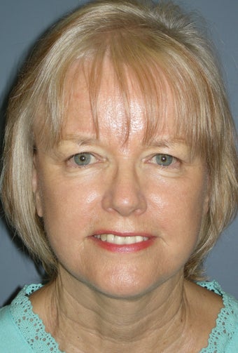 LiteLift™, Liposuction on 65-year-old Woman after 423094