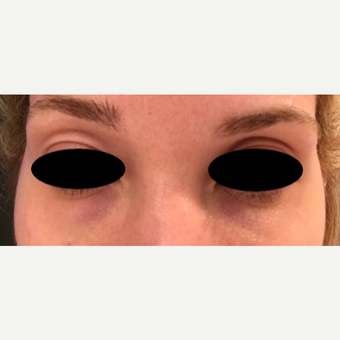 25-34 year old woman treated with Eye Bags Treatment with Restylane Silk after 3501076