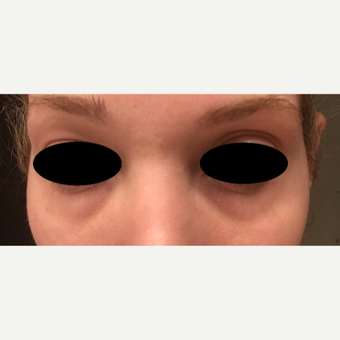 25-34 year old woman treated with Eye Bags Treatment with Restylane Silk before 3501076