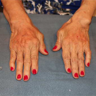 65-74 year old woman treated with Radiesse in the hands after 3484665