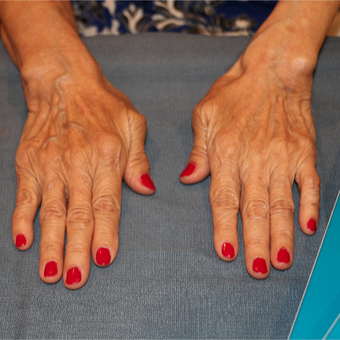 65-74 year old woman treated with Radiesse in the hands before 3484665