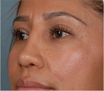 Rhinoplasty after 1378010