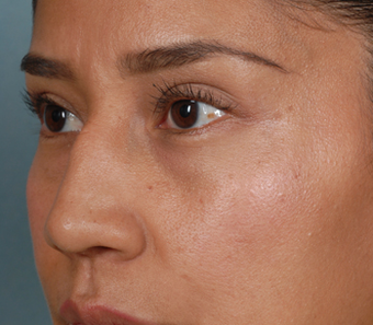 Rhinoplasty before 1378010