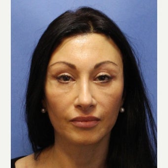 Young patient underwent endoscopic face lifting and 4 lids blepharoplasty after 2353981