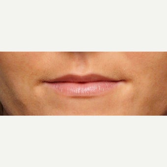 35-44 year old woman treated with Lip Augmentation before 1707955