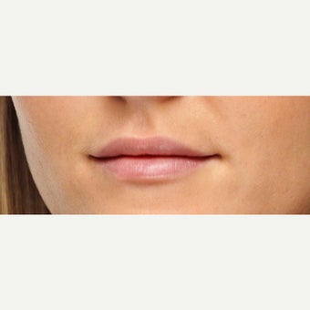 35-44 year old woman treated with Lip Augmentation after 1707955