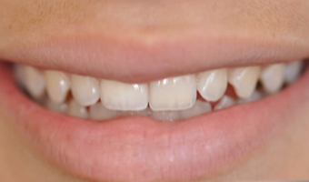 25-34 year old woman treated with Porcelain Veneers after 3804894