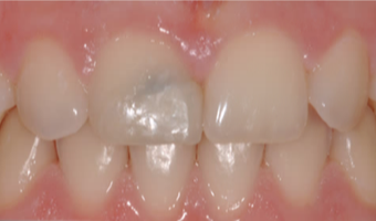 25-34 year old woman treated with Porcelain Veneers before 3804894