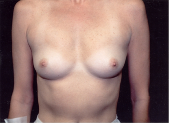 40-year-old woman treated with Breast Augmentation. before 341962