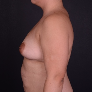 25-34 year old woman treated with Mentor Breast Implants before 3240097