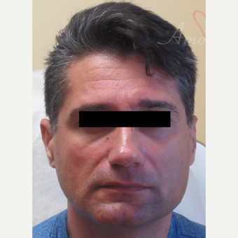 45-54 year old man treated with Voluma in the cheeks area before 3263721
