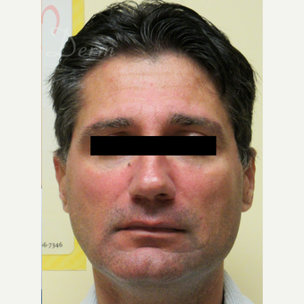 45-54 year old man treated with Voluma in the cheeks area after 3263721
