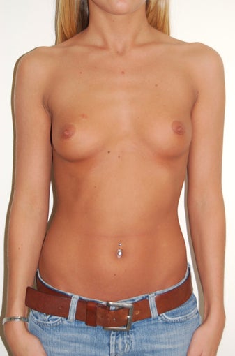 Breast Augmentation before 575099