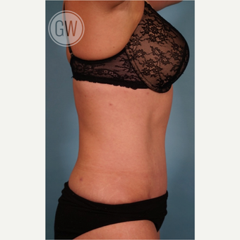 35-44 year old woman treated with Tummy Tuck after 3016624