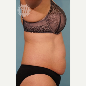 35-44 year old woman treated with Tummy Tuck before 3016624