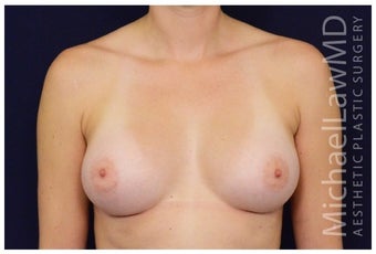 Breast Augmentation after 1326146