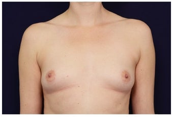 Breast Augmentation before 1326146