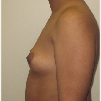 18-24 year old woman treated with Breast Implants before 3424593