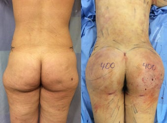 Brazilian Butt Lift before 1503913