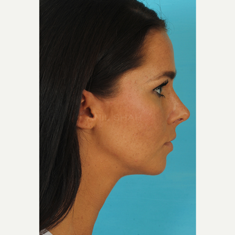 25-34 year old woman treated with Rhinoplasty after 3629341