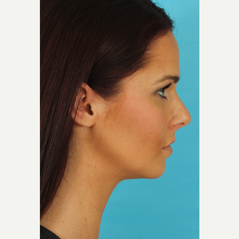 25-34 year old woman treated with Rhinoplasty before 3629341