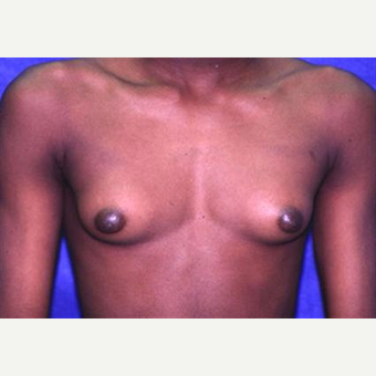 17 or under year old man treated with Male Breast Reduction before 3066252