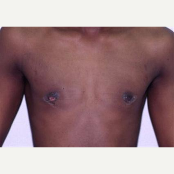 17 or under year old man treated with Male Breast Reduction after 3066252