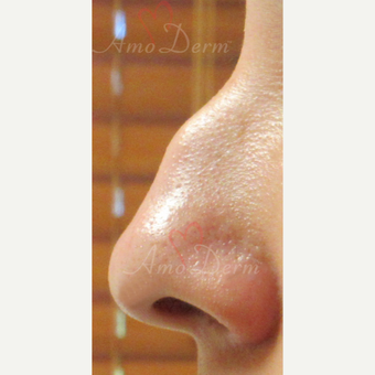 25-34 year old woman treated with Voluma for non-surgical nose job before 3381457