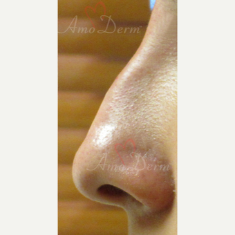 25-34 year old woman treated with Voluma for non-surgical nose job after 3381457