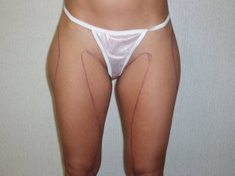 Liposuction of Thighs before 55471