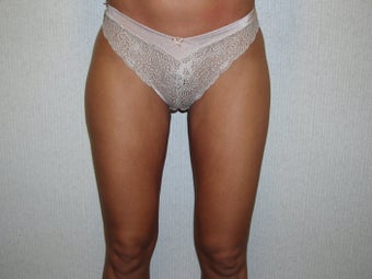 Liposuction of Thighs after 55471