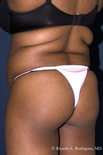 Brazilian Butt Lift before 242792