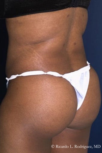 Brazilian Butt Lift after 242792