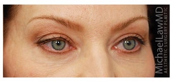 Eye Bag Treatment after 1270463