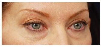 Eye Bag Treatment before 1270463