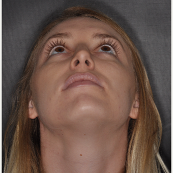 18-24 year old woman treated with Nose Surgery 1 year post-op after 3499852
