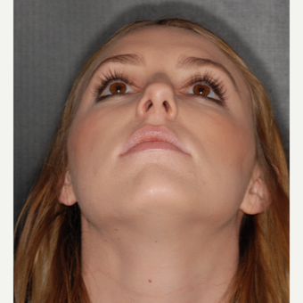 18-24 year old woman treated with Nose Surgery 1 year post-op before 3499852