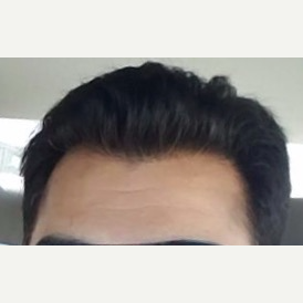 45-54 year old man treated with FUE Hair Transplant after 3777954