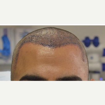 45-54 year old man treated with FUE Hair Transplant before 3777954