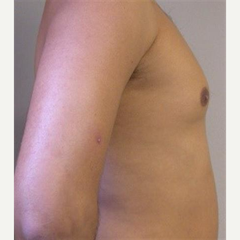 25-34 year old man treated with Pec Implants before 3093275