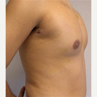 25-34 year old man treated with Pec Implants after 3093275