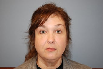 45-54 year old woman treated with Eye Bags Treatment after 1580198