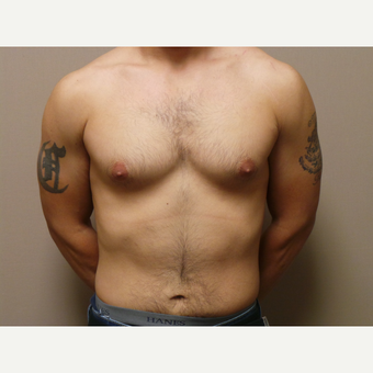 25-34 year old man treated with Male Breast Reduction before 3454710