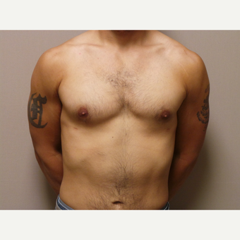 25-34 year old man treated with Male Breast Reduction after 3454710