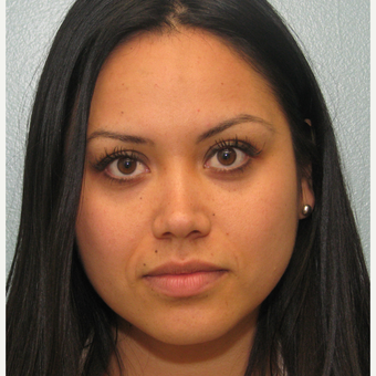 25-34 year old woman treated with Injectable Fillers using Radiesse and Botox after 3137257