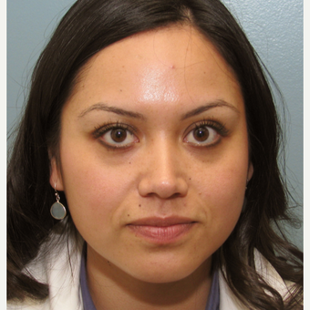 25-34 year old woman treated with Injectable Fillers using Radiesse and Botox before 3137257